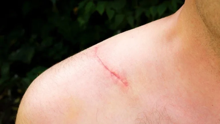 Skin Care: How Long for Scars to Fade
