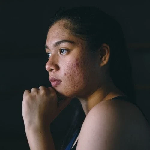 Foods that Cause Acne – According to Dermatologists