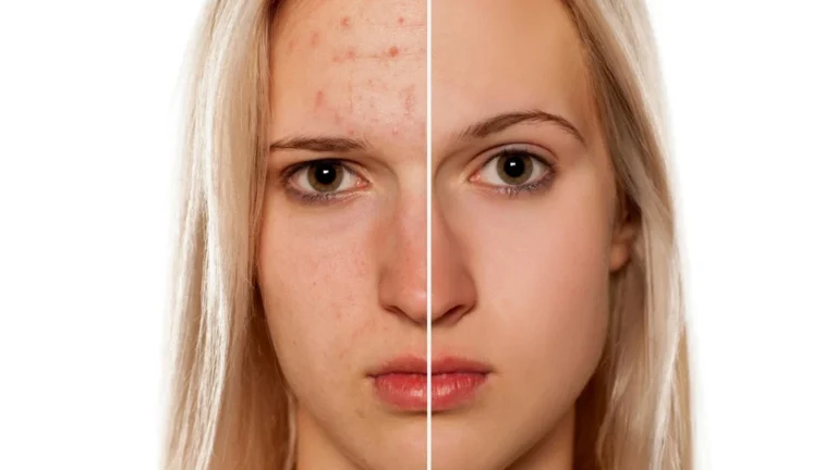 What Is Hormonal Acne? Everything You Need to Know