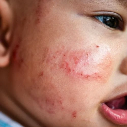 Infant Eczema: Baby Skin Care And Baby Diaper Rash Care