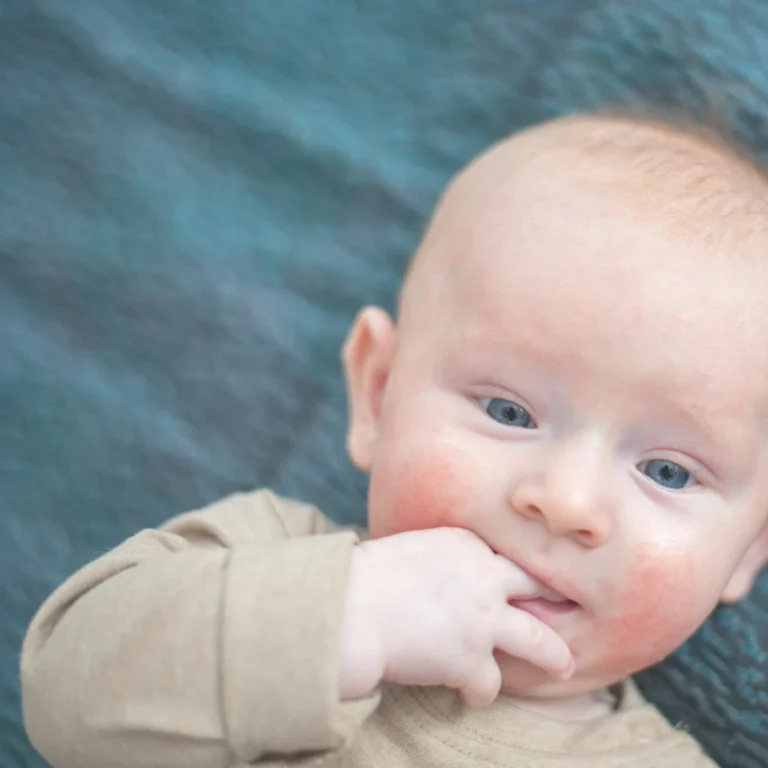 Signs Of Food Allergies In Babies