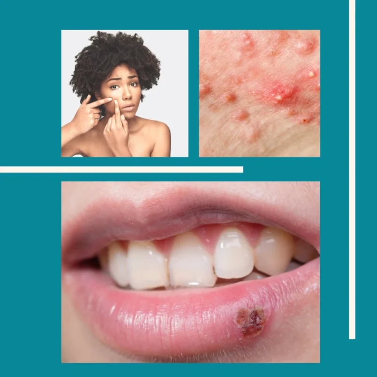 Pimples Vs Cold Sores