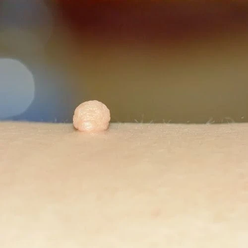 Vaginal Skin Tags Causes, Symptoms & Treatment