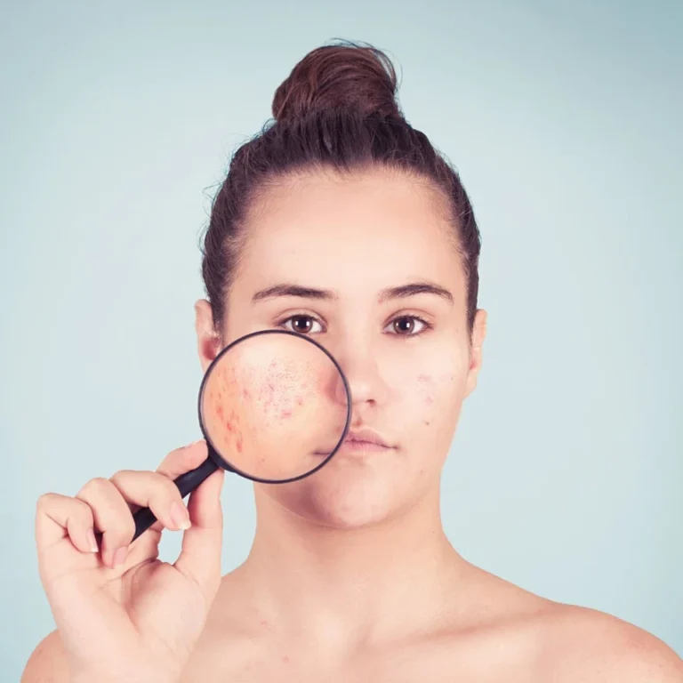Is PCOS Treatable?