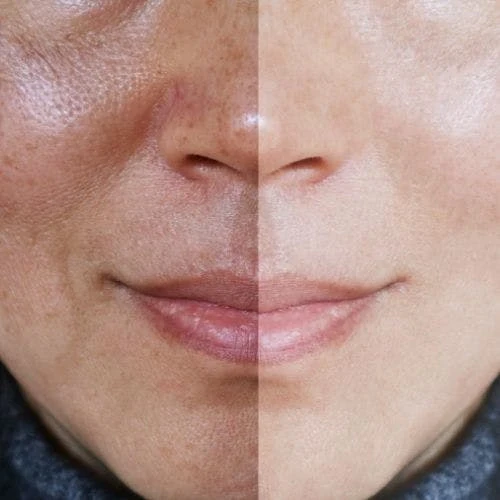 Sun Spot Removal: The Helpful Methods to Try