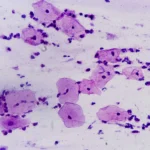 Can A Pap Smear Detect STD Sexually Transmitted Disease